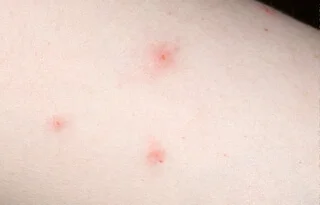 Picaduras de chinches de cama