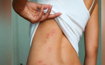 ¿Cómo son las picaduras de chinches de cama?